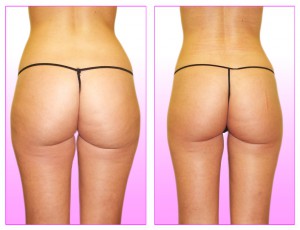 Les techniques anti cellulite